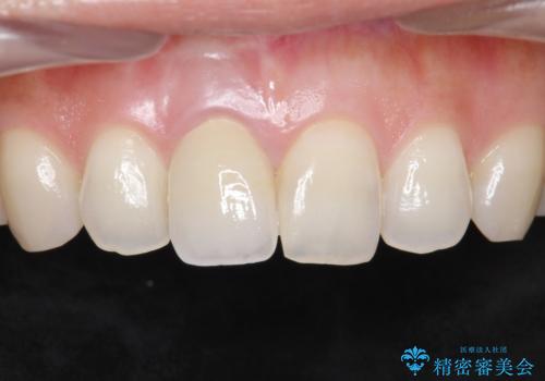 差し歯をもっと自然に 30代女性の症例 治療後