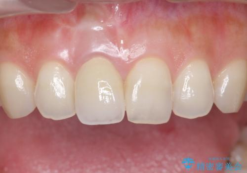 差し歯をもっと自然に 30代女性の治療後