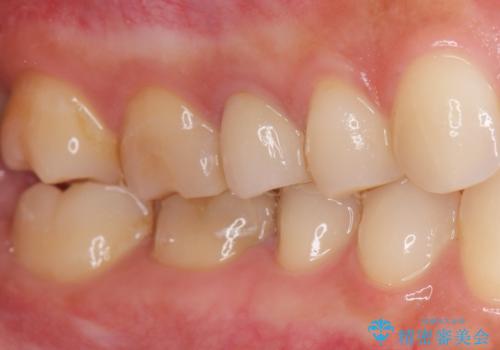 差し歯をもっと自然に 30代女性の治療後