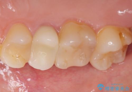 差し歯をもっと自然に 30代女性の治療後
