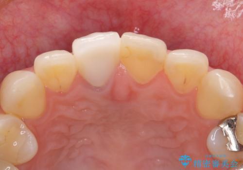 差し歯をもっと自然に 30代女性の治療後