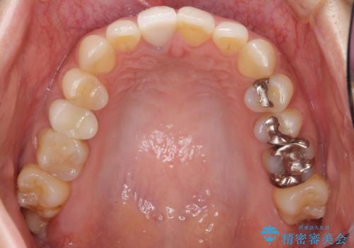 差し歯をもっと自然に 30代女性の治療後