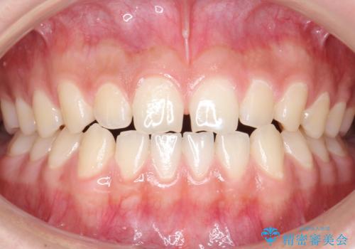 前歯のすきま　受け口　インビザラインでの症例 治療前