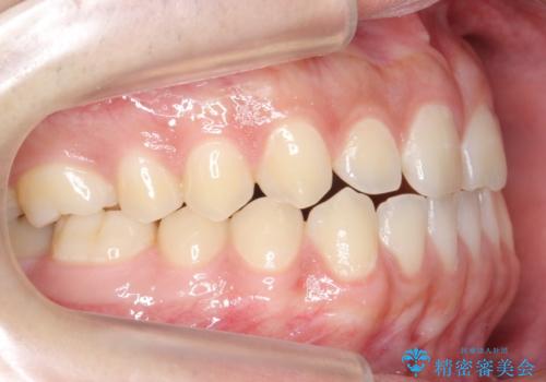 前歯のすきま　受け口　インビザラインでの治療前