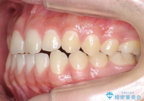 前歯のすきま 受け口 インビザラインでの治療前