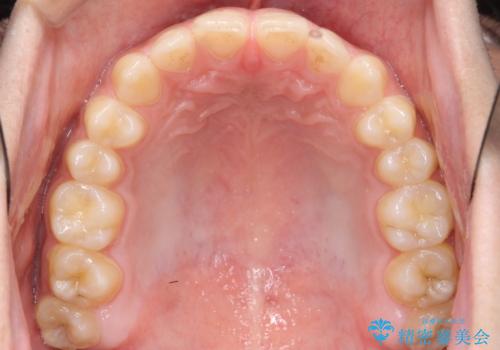 前歯のすきま 受け口 インビザラインでの治療前