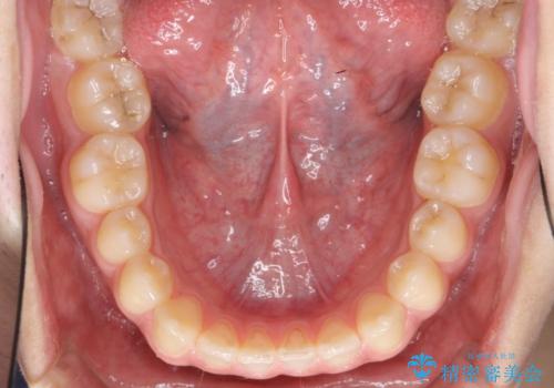 前歯のすきま 受け口 インビザラインでの治療前
