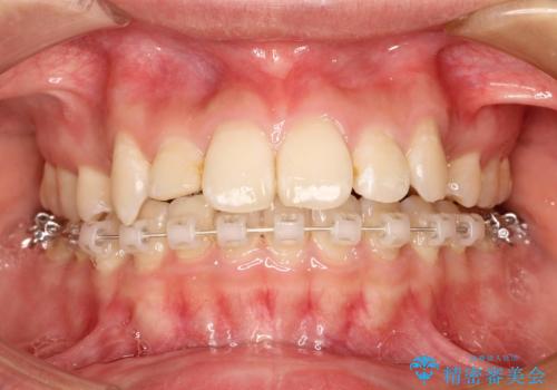 ハーフリンガル矯正 抜歯をして前歯を下げるの治療中