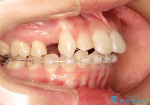 ハーフリンガル矯正 抜歯をして前歯を下げるの治療中