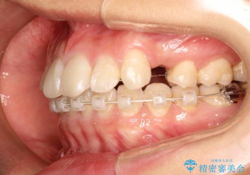 ハーフリンガル矯正 抜歯をして前歯を下げるの治療中