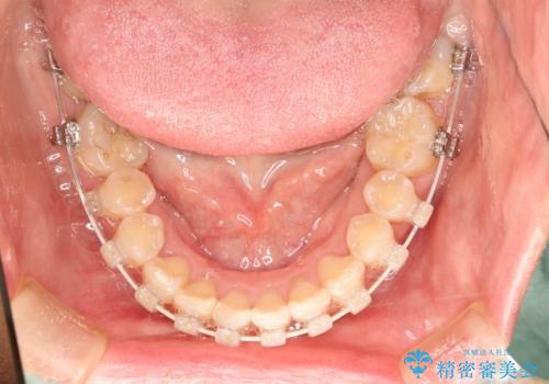 ハーフリンガル矯正 抜歯をして前歯を下げるの治療中