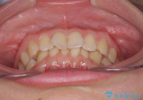 インビザラインによる前歯の矯正治療の治療前