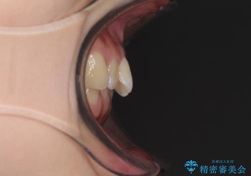 インビザラインによる前歯の矯正治療の治療前