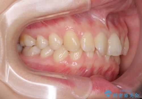 インビザラインによる前歯の矯正治療の治療前