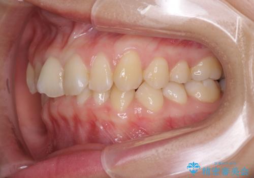 インビザラインによる前歯の矯正治療の治療前