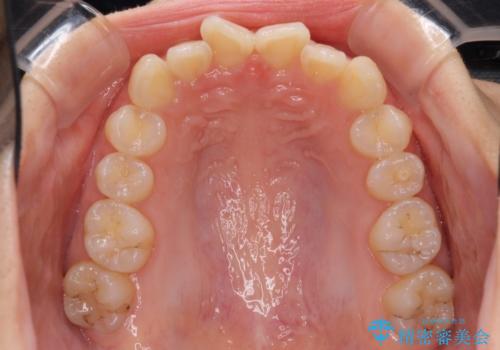 インビザラインによる前歯の矯正治療の治療前