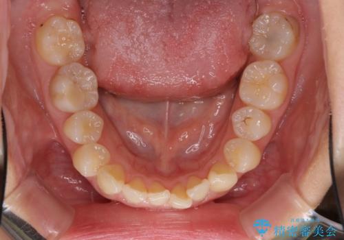 インビザラインによる前歯の矯正治療の治療前