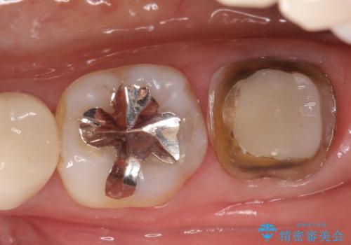 奥歯が痛い。根管治療からセラミッククラウンの治療中