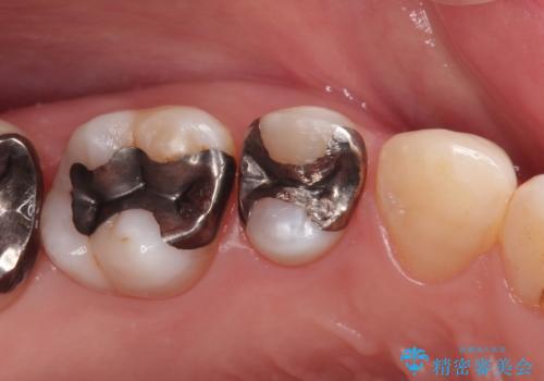 笑ったら銀歯が見える。 セラミックインレーによる治療の症例 治療前