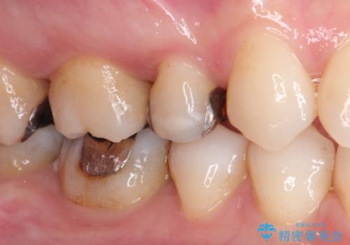 笑ったら銀歯が見える。 セラミックインレーによる治療の治療前