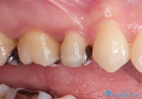 笑ったら銀歯が見える。 セラミックインレーによる治療の治療前