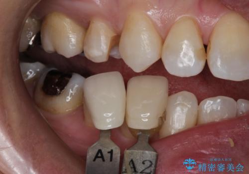笑ったら銀歯が見える。 セラミックインレーによる治療の治療中