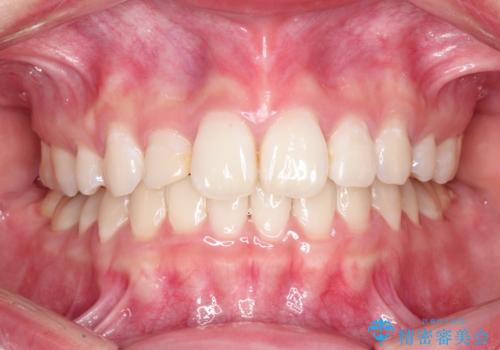 ハーフリンガル矯正 抜歯をして前歯を下げるの治療後