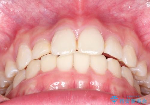 ハーフリンガル矯正 抜歯をして前歯を下げるの治療後