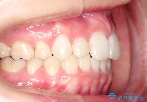 ハーフリンガル矯正　抜歯をして前歯を下げるの症例 治療後