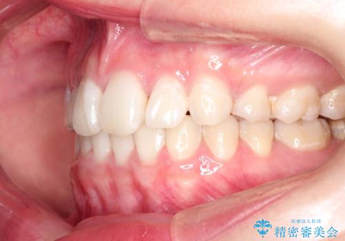 ハーフリンガル矯正 抜歯をして前歯を下げるの治療後