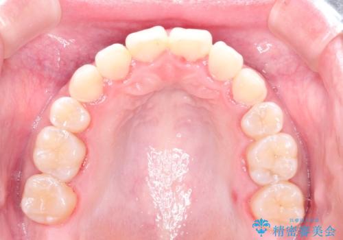 ハーフリンガル矯正 抜歯をして前歯を下げるの治療後