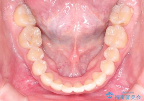 ハーフリンガル矯正 抜歯をして前歯を下げるの治療後