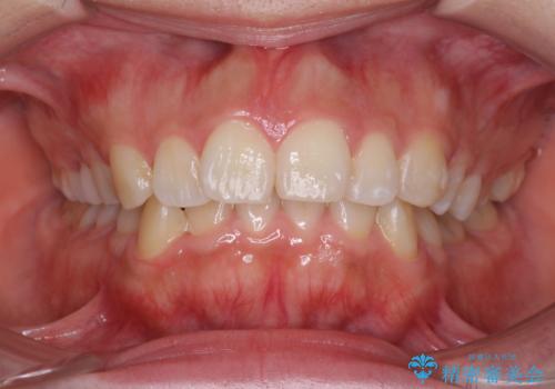 前歯がでていて口が閉じずらい　ワイヤーによる抜歯矯正の治療前