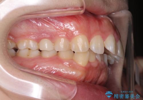 前歯がでていて口が閉じずらい　ワイヤーによる抜歯矯正の症例 治療前