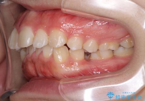 前歯がでていて口が閉じずらい　ワイヤーによる抜歯矯正の治療前