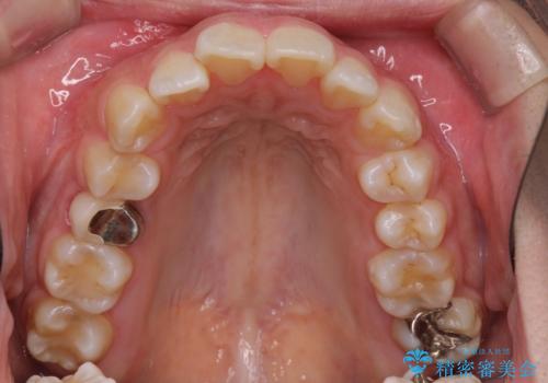 前歯がでていて口が閉じずらい ワイヤーによる抜歯矯正の治療前