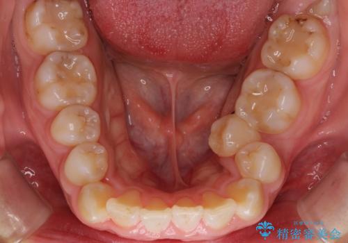 前歯がでていて口が閉じずらい ワイヤーによる抜歯矯正の治療前