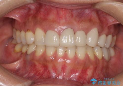歯肉の高さをそろえたい　前歯の審美歯科治療の治療前