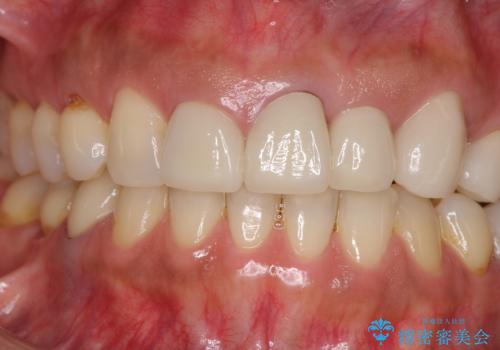 歯肉の高さをそろえたい 前歯の審美歯科治療の治療前