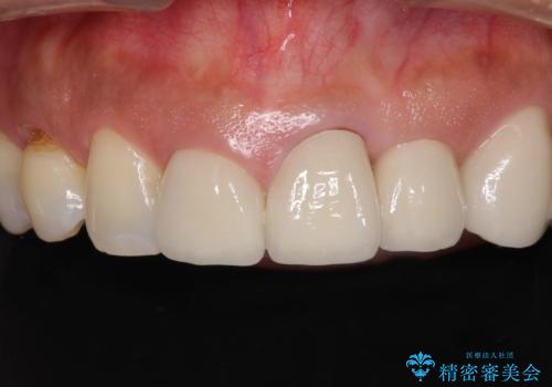 歯肉の高さをそろえたい 前歯の審美歯科治療の症例 治療前