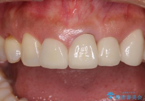 歯肉の高さをそろえたい 前歯の審美歯科治療の治療前