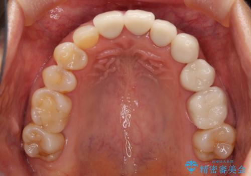 歯肉の高さをそろえたい 前歯の審美歯科治療の治療前