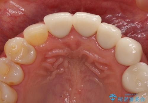 歯肉の高さをそろえたい 前歯の審美歯科治療の治療前