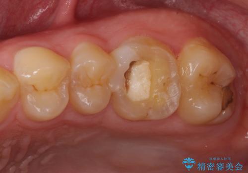 根管治療中の転院　奥歯のオールセラミック治療の症例 治療前