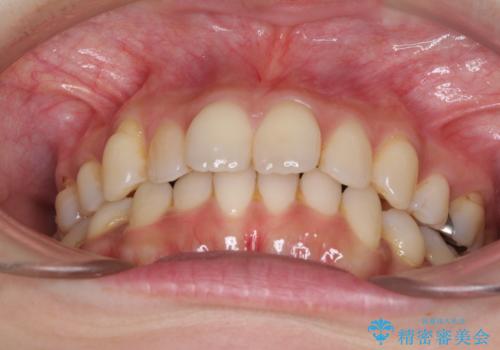 軽度な歯列不正 インビザライン・ライトによる矯正治療の治療前
