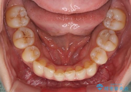 軽度な歯列不正 インビザライン・ライトによる矯正治療の治療前