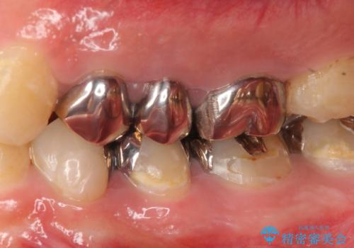 オールセラミッククラウン 根管治療・深い虫歯の治療の治療前