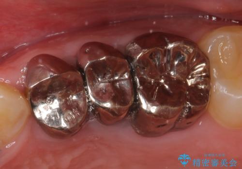 オールセラミッククラウン 根管治療・深い虫歯の治療の症例 治療前