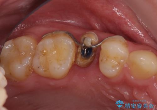 割れた歯を引っ張り出す　右上と左上の虫歯治療の治療中