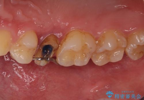 割れた歯を引っ張り出す　右上と左上の虫歯治療の治療中